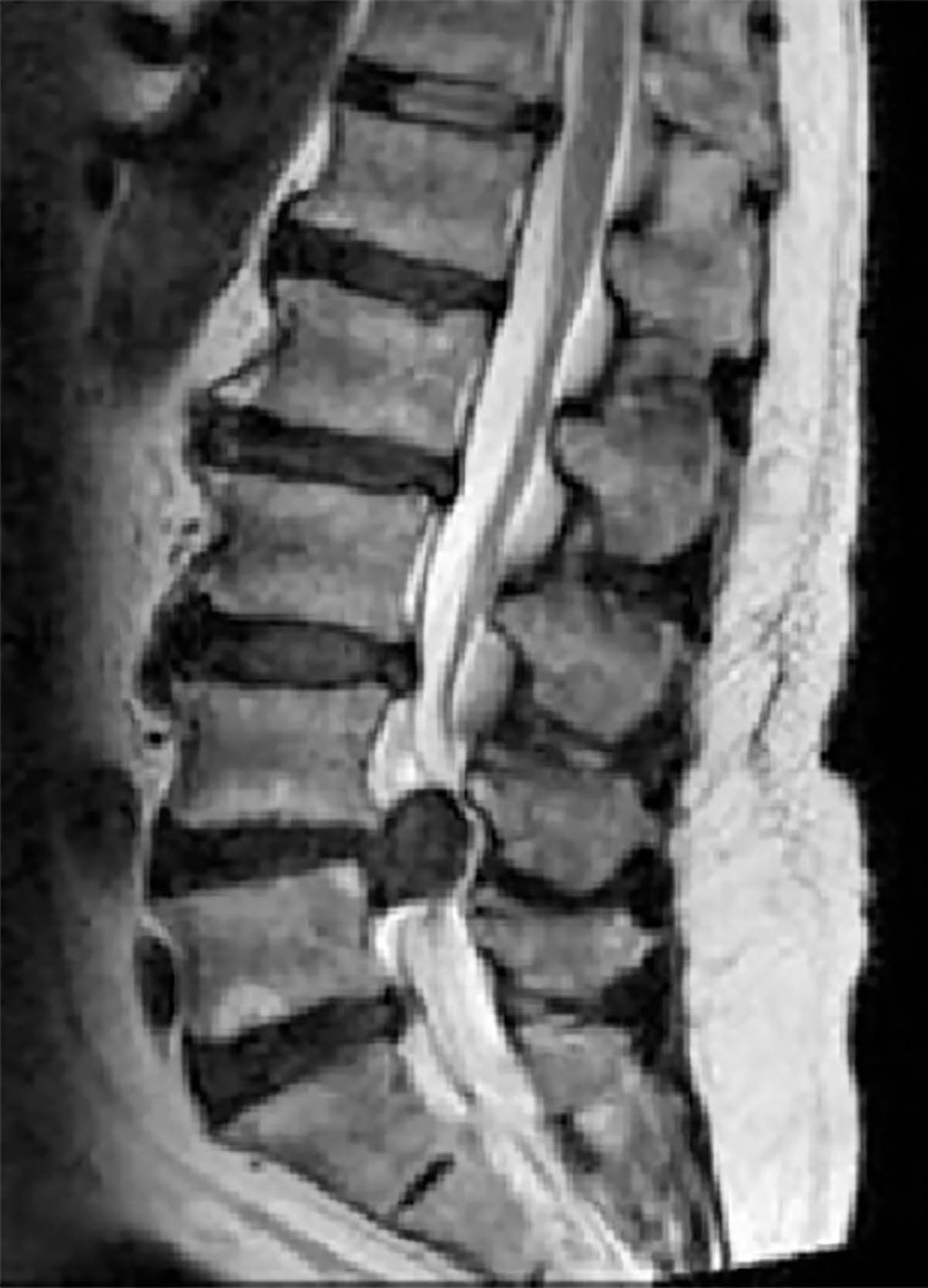 Durerea lombară în afecțiunile degenerative ale coloanei - abordarea neurochirurgului