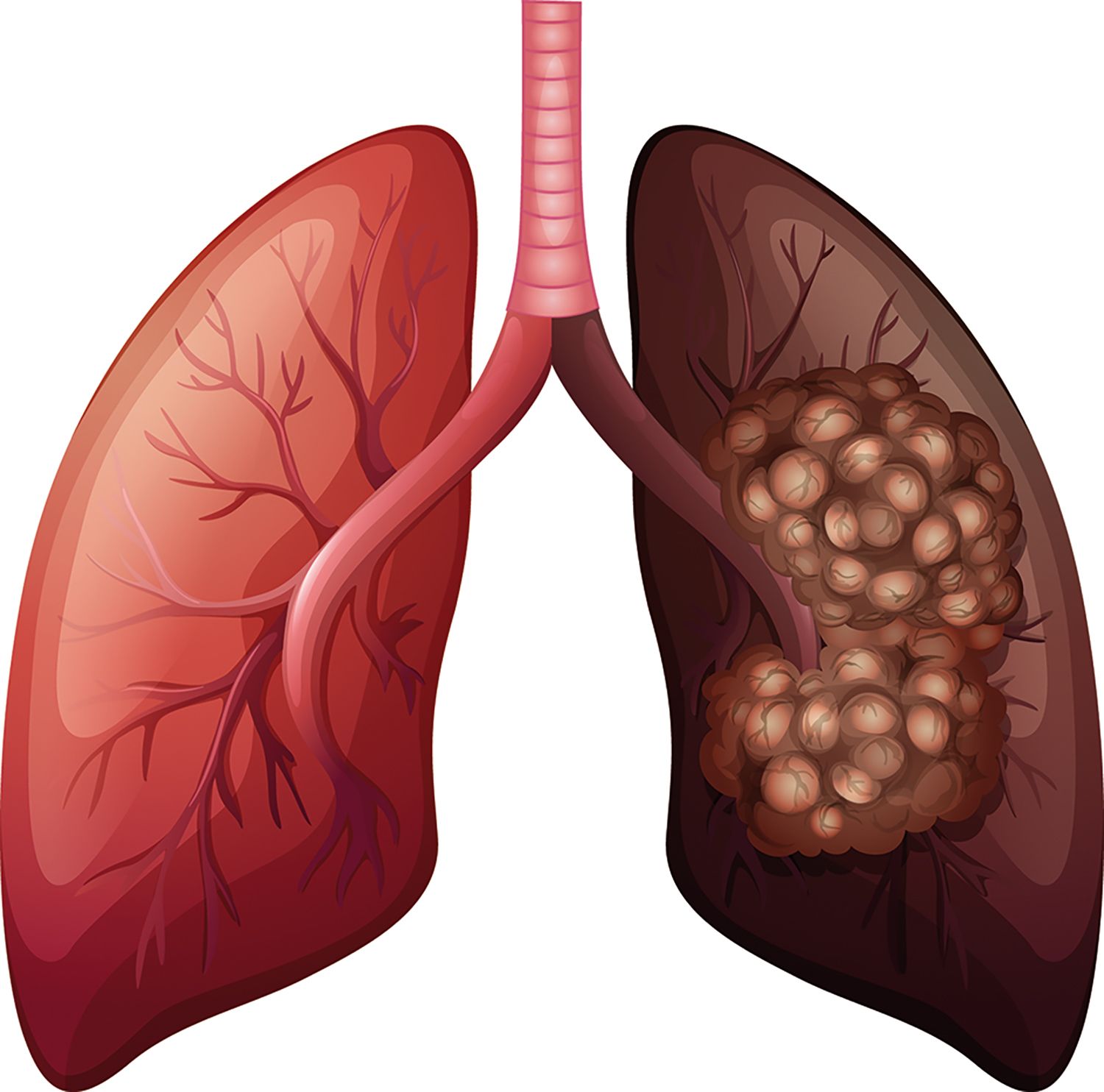 Identificarea mutațiilor din cancerul pulmonar