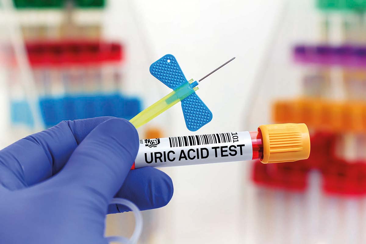 Monitorizarea acidului uric previne atacurile de gută
