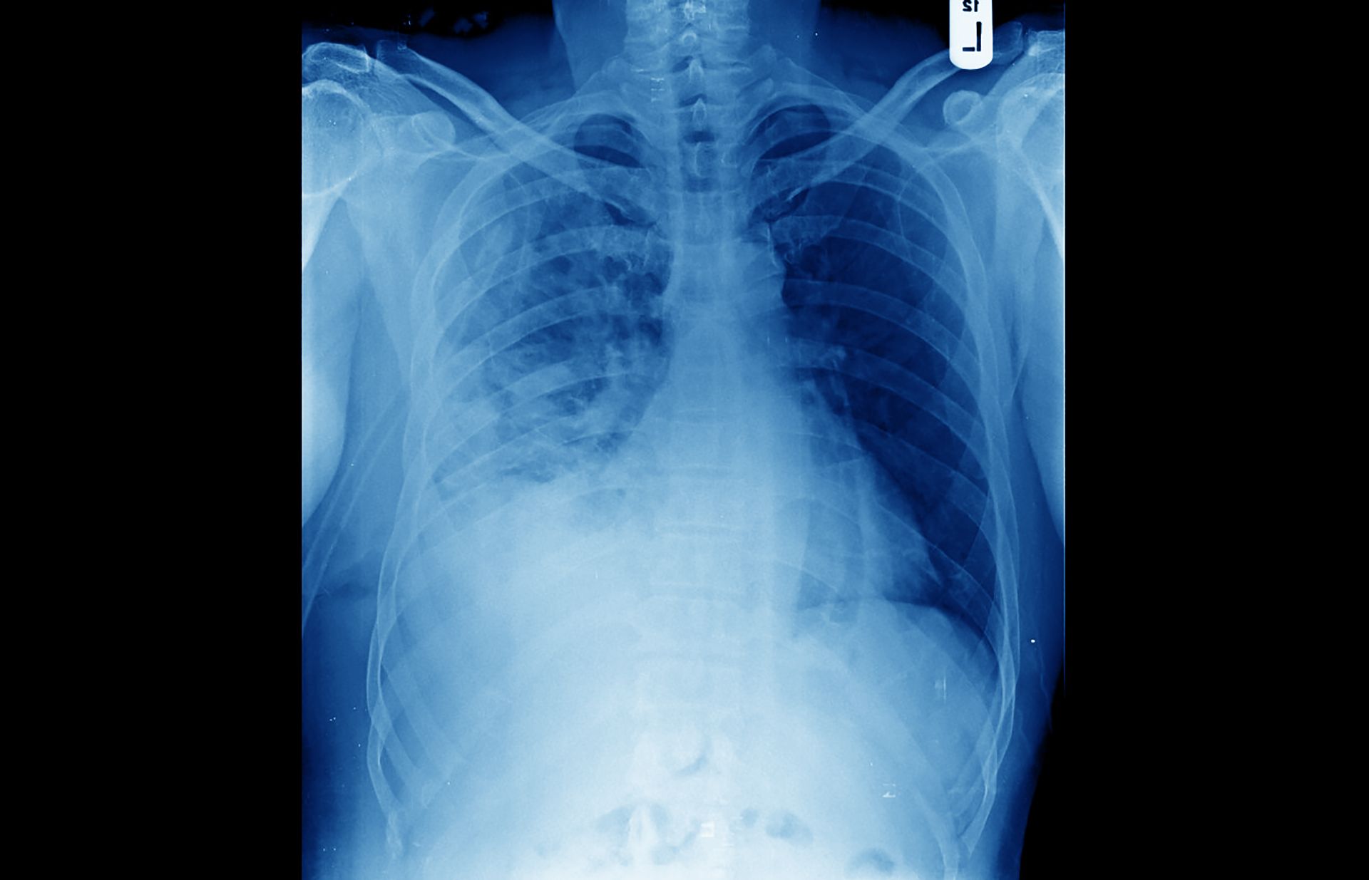 Radiografia pentru un pacient cu dispnee indică revărsat pulmonar masiv drept