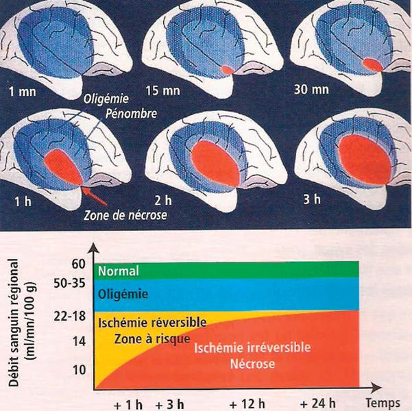 Mismatch şi zonă de „penumbră“ în infarctul cerebral acut (III)