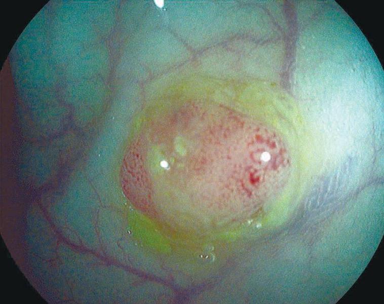 Screeningul colonoscopic al cancerului colorectal