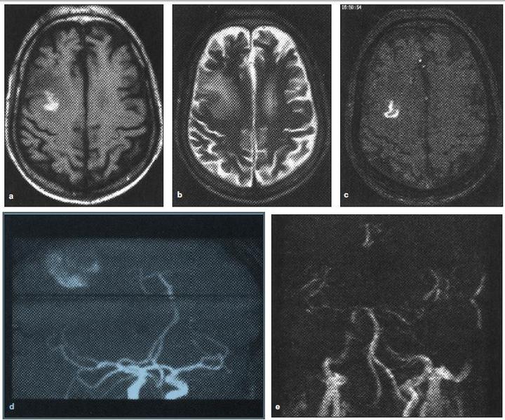 Interferenţe neuro-cardiologice în urgenţele de cauză vasculară (2)