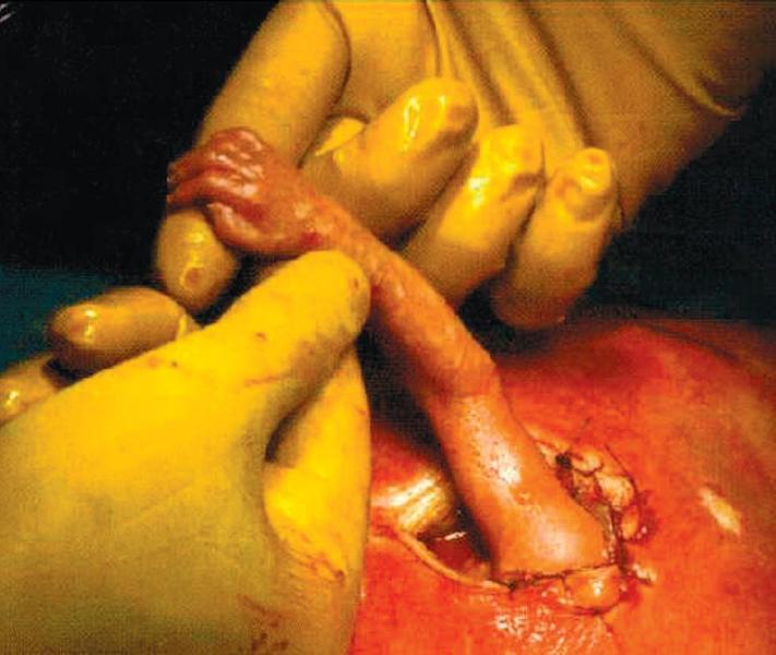 Diagnosticul prenatal şi managementul operator intrauterin al anomaliilor fetale corectabile