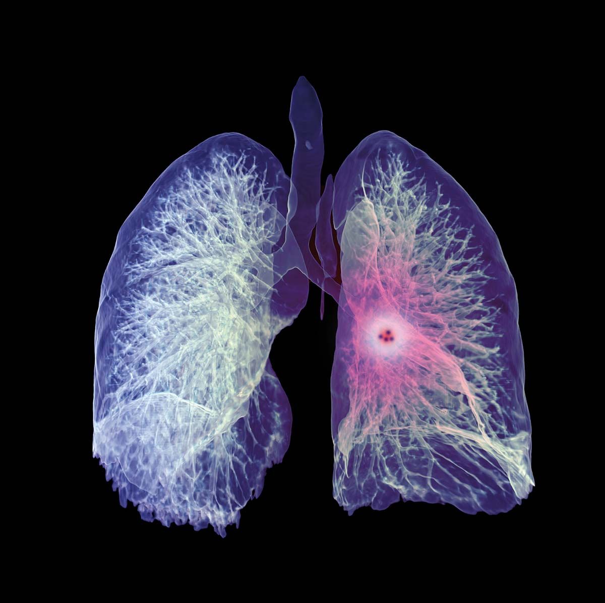 Tratament nou în cancerul pulmonar