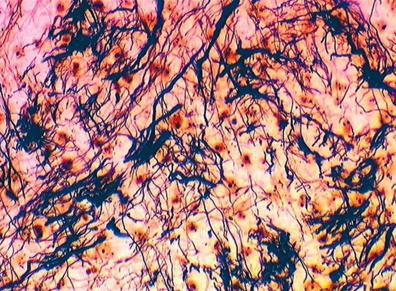 Biomarkeri şi electrodiagnostic