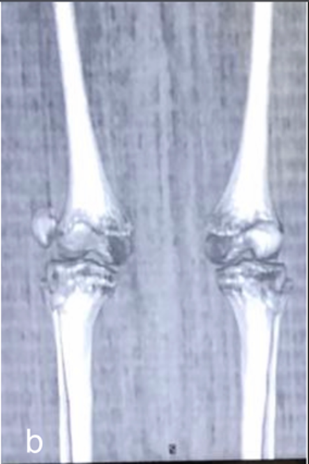 refacerea luxației genunchiului pastile pentru durere în articulația piciorului