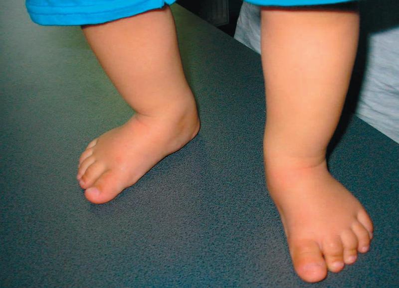 Piciorul plat la copil