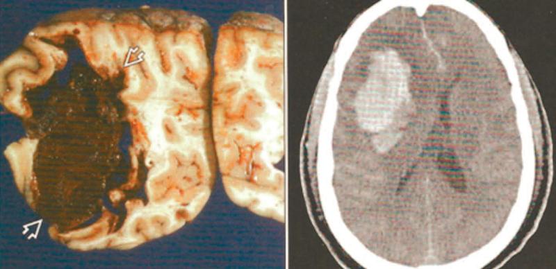Accidentele vasculare cerebrale grave: tratamentul în reanimare