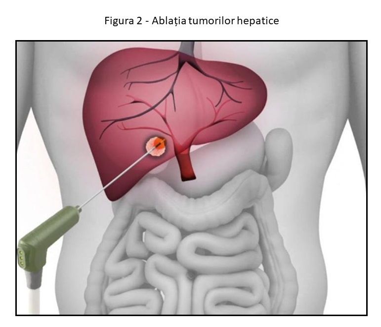 Ablatia tumorilor hepatice