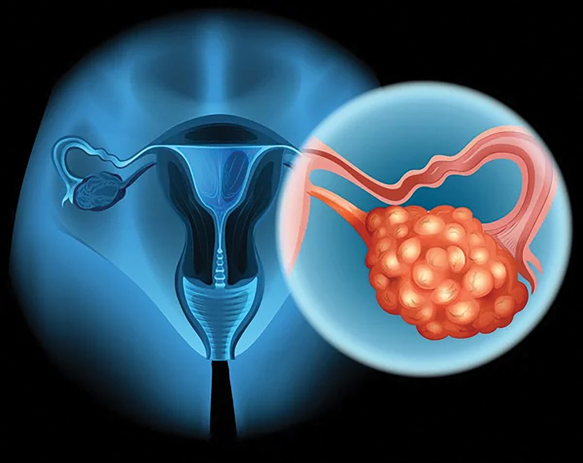 Un test de urină ar putea depista cancerul ovarian precoce