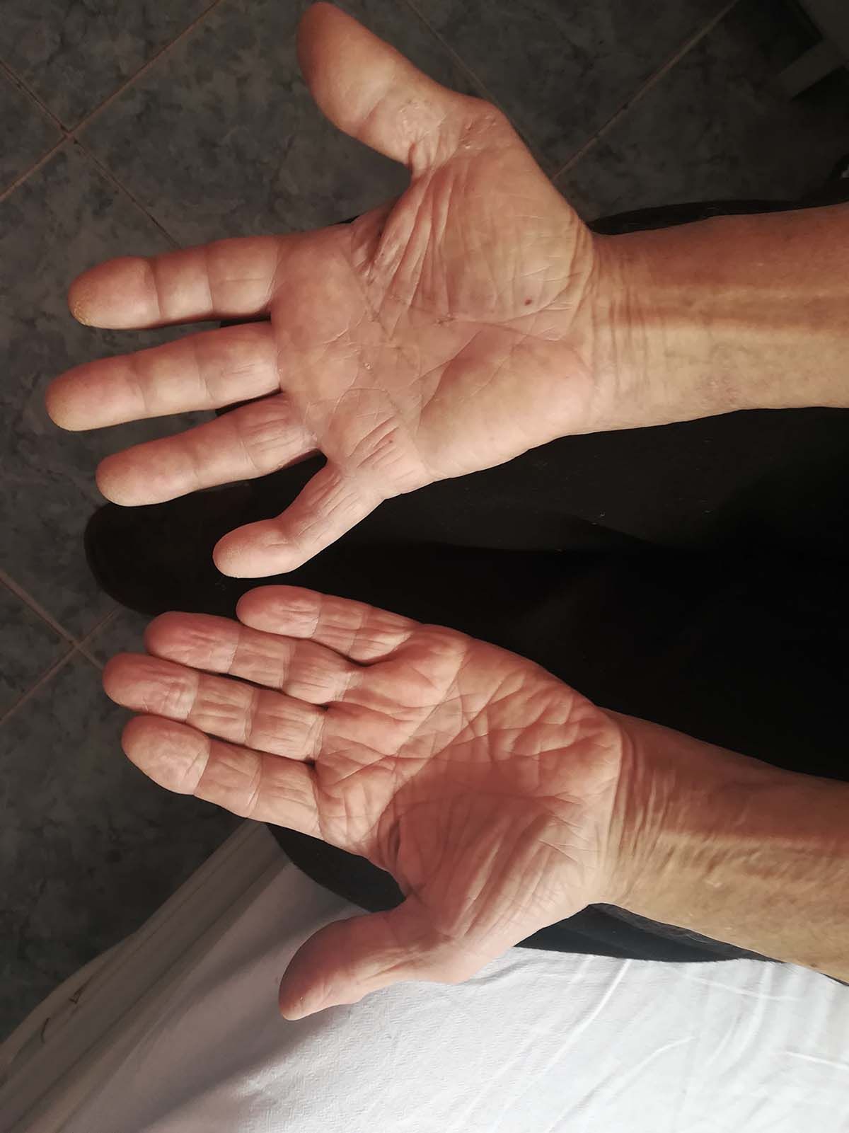 Caz plexita brahiala img3