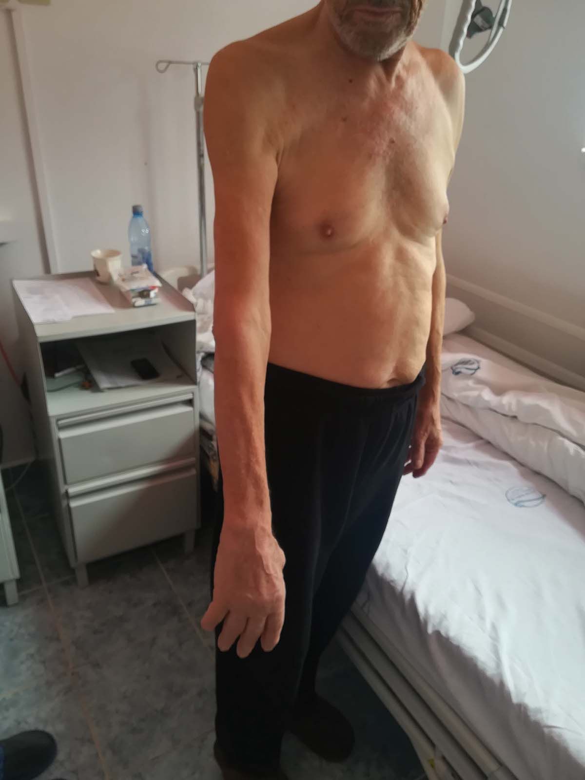 Caz plexita brahiala img4