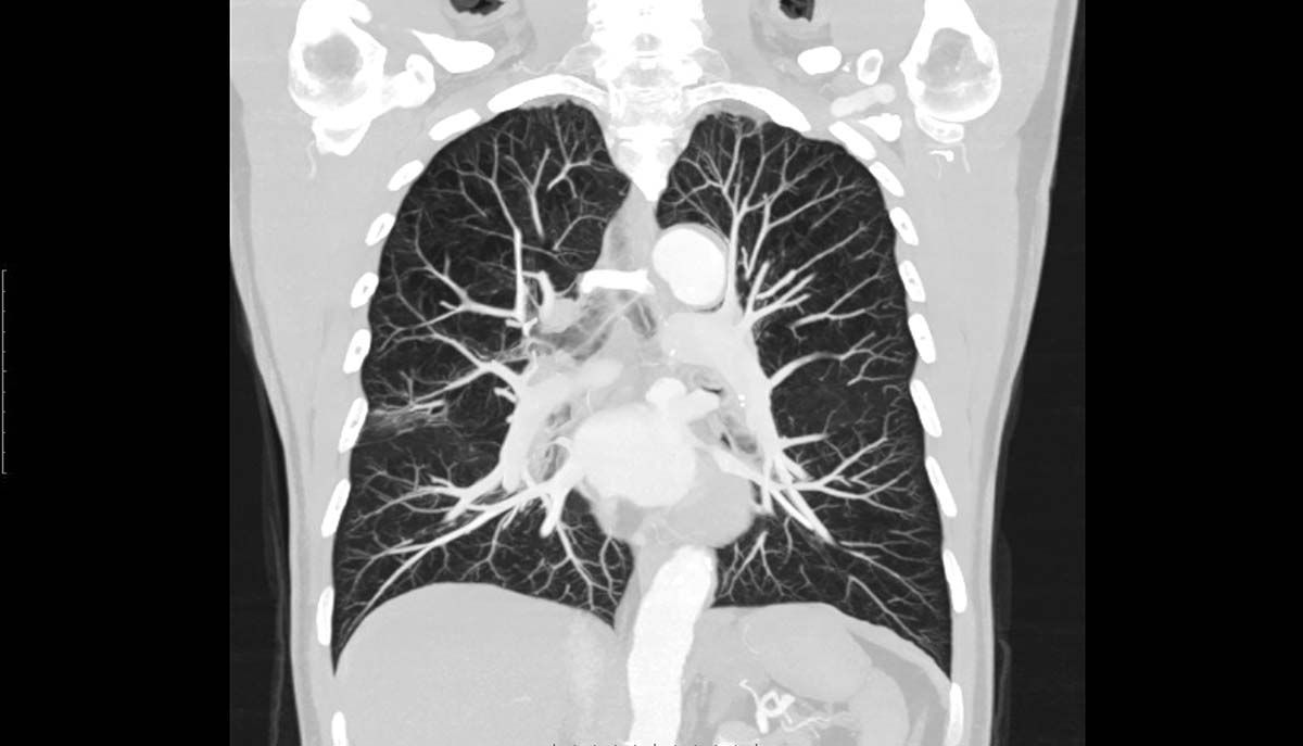 Embolia pulmonară descoperită accidental