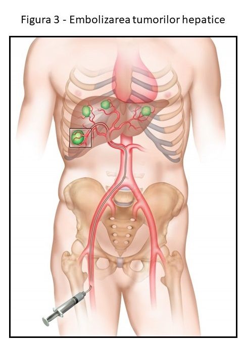 Embolizarea tumorilor hepatice