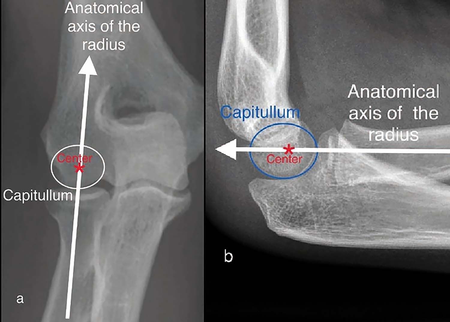 dureri și umflături la nivelul articulației genunchiului
