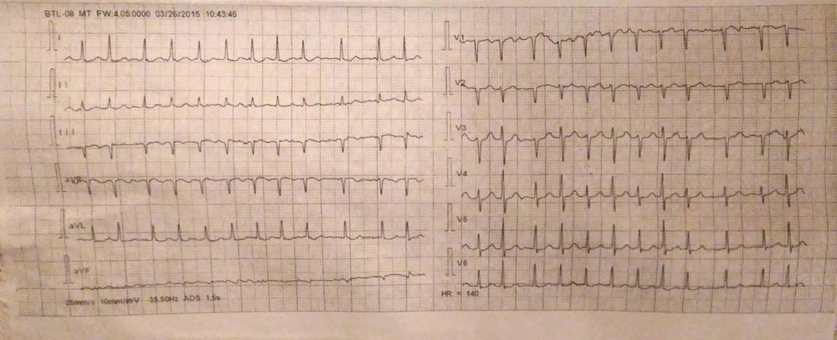 Fig. 1. Fibrilație atrială paroxistică survenită &icirc;n convalescența COVID-19