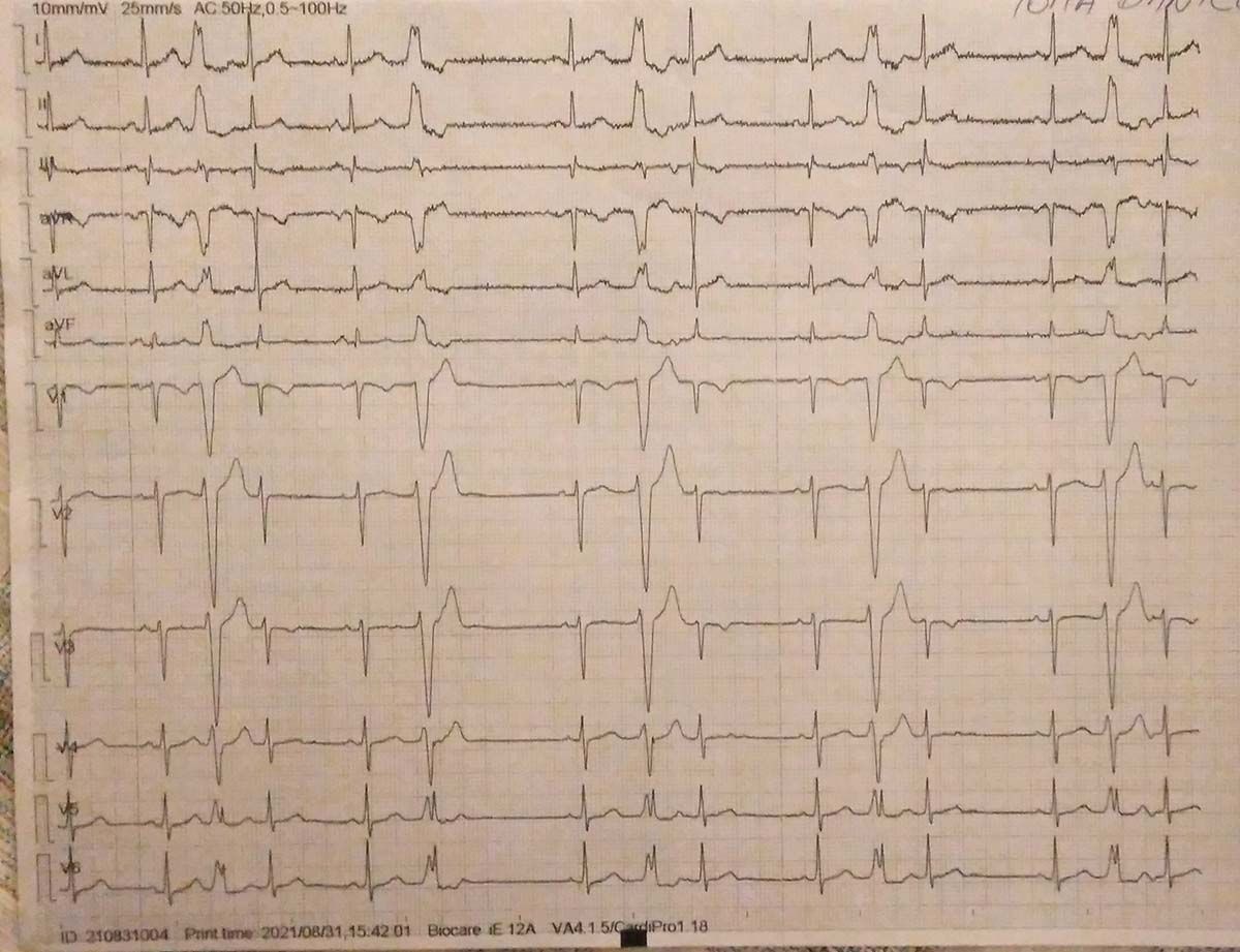 Fig. 2. Traseul amplu - Extrasistole ventriculare monofocale post COVID-19