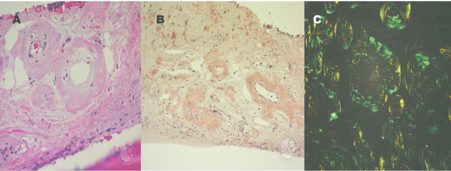 Fig. 3. Amiloidoză A. Hematoxilină-eozină B. Roșu de Congo C. Birefringență galben-verzuie(Colorație Roșu de Congo în lumina polarizată)