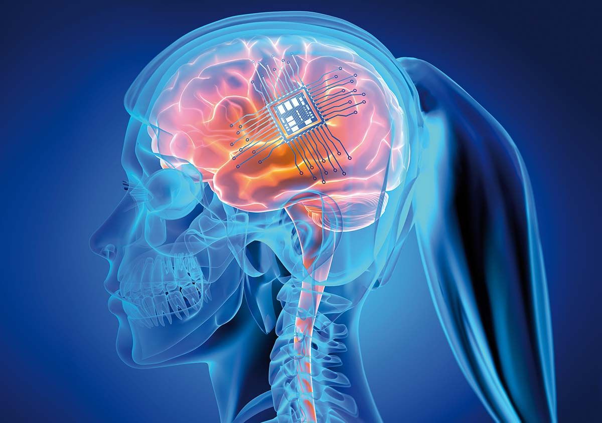 Implant pentru tratamentul bolilor neurologice