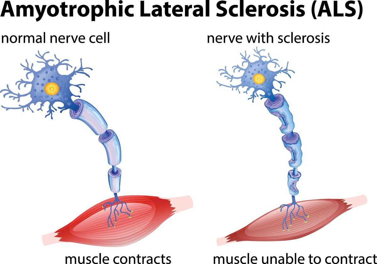 O nouă descoperire în lupta împotriva sclerozei laterale amiotrofice