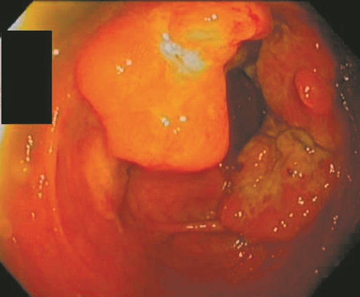 SINDROMUL DE INTESTIN IRITABIL