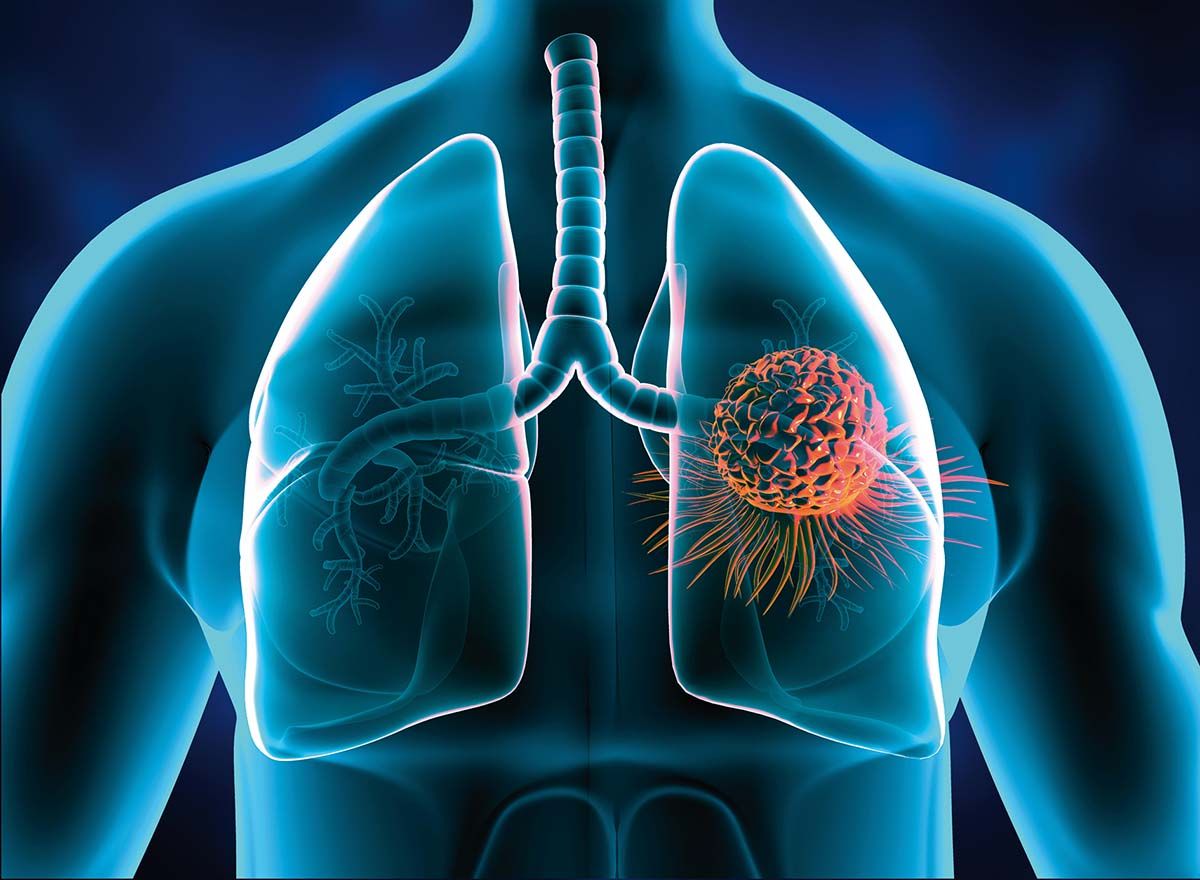 Tratamentul cancerului  bronhopulmonar nonmicrocelular - forma localizată