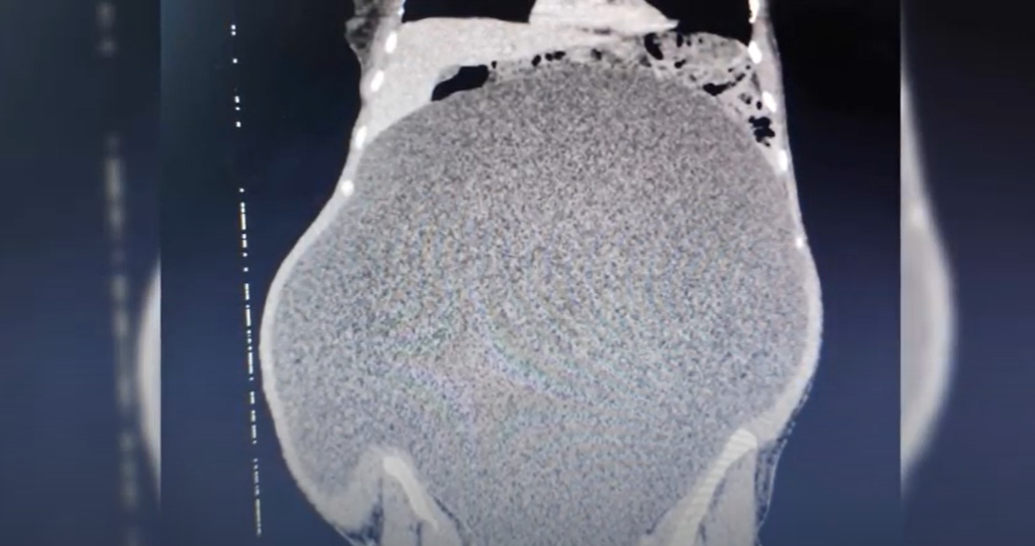 Tumoră ovariană voluminoasă, extirpată la Spitalul Militar Central