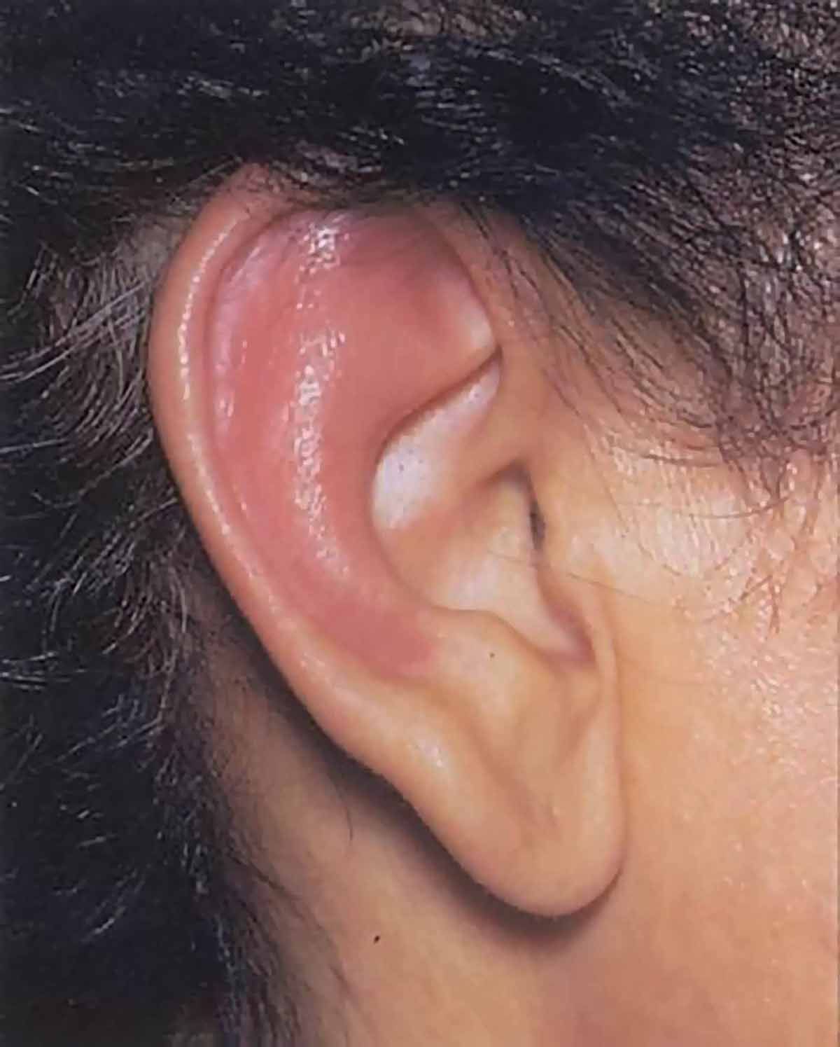 Ureche în plin atac de policondrită