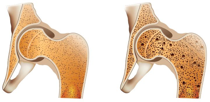 Tratamentul actual în osteoporoza postmenopauză
