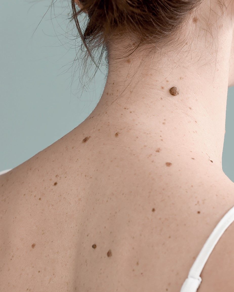 Direcţii actuale în tratamentul melanomului