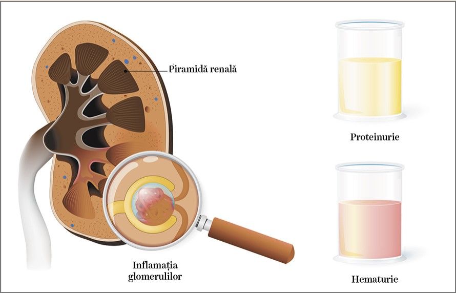 GLOMERULONEFRITA LUPICĂ, o urgenţă terapeutică