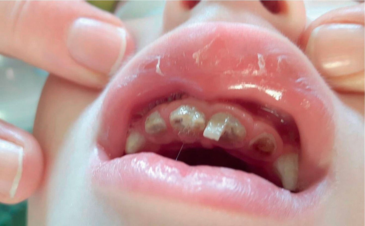 Caria dentară precoce, efectul lipsei programelor de prevenţie