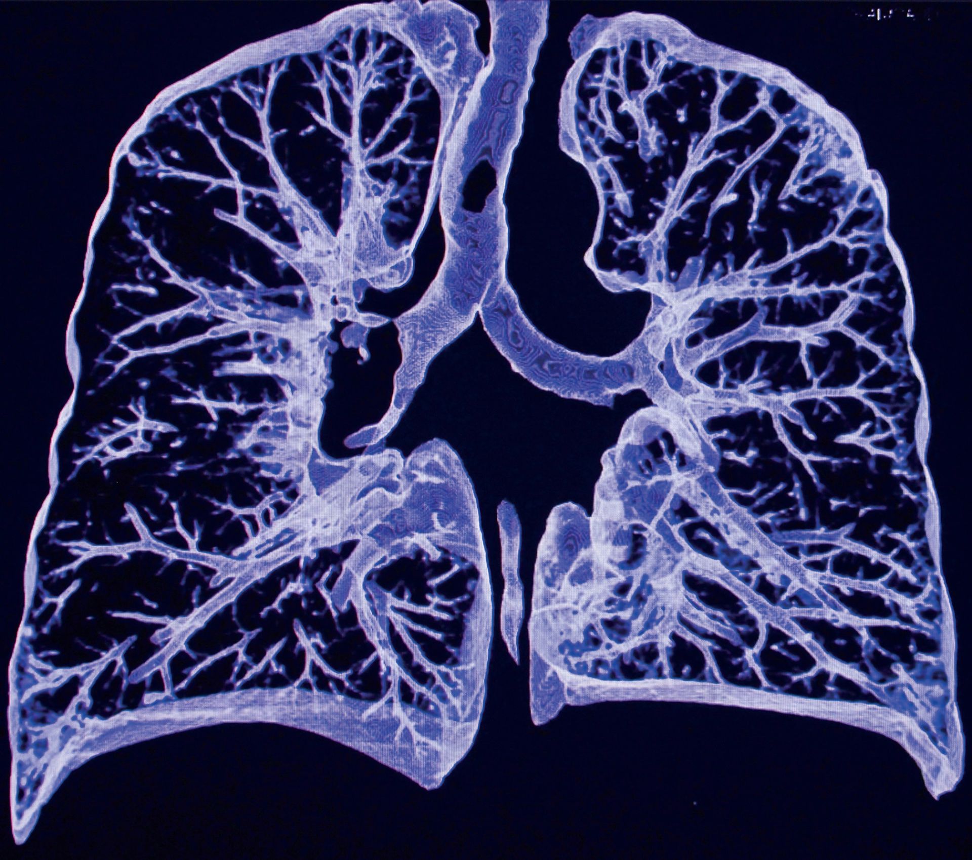 Cancerul pulmonar, de la simptom la screening