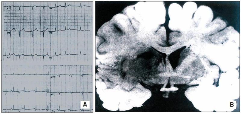 Boala cardiacă neurogenă