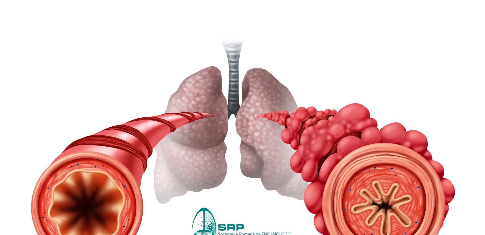 Astmul netratat, costuri mai mari pentru sistemul de sănătate
