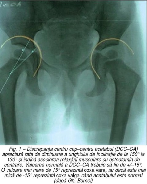 Tehnica Burnei de corectare a diformităţii în var sau valg a colului femural din osteogeneza imperfectă 