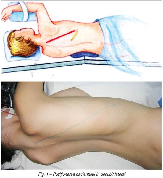 Abordul somatic retropleural Burnei – o nouă tehnică operatorie pentru tratamentul afecţiunilor rahisului toracic