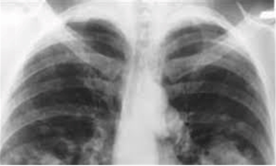 Medic din Timișoara: Riscul de a dezvolta cancer pulmonar scade odată cu renunțarea la fumat