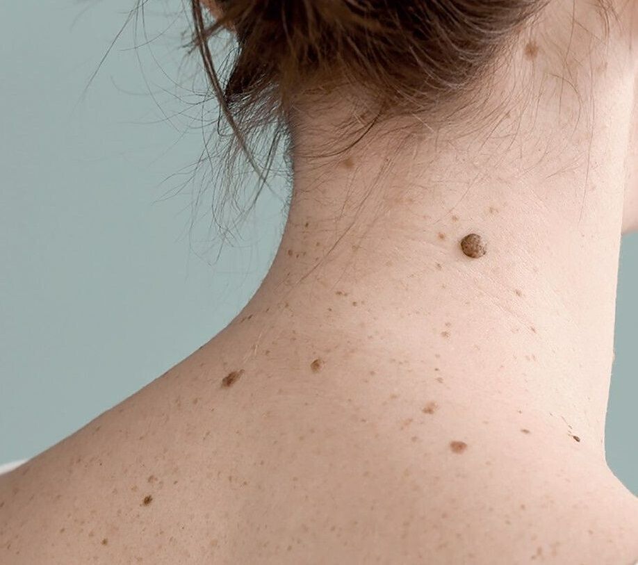 Dermatologii au depistat cel mai mic cancer de piele - Au intrat in Cartea Recordurilor 