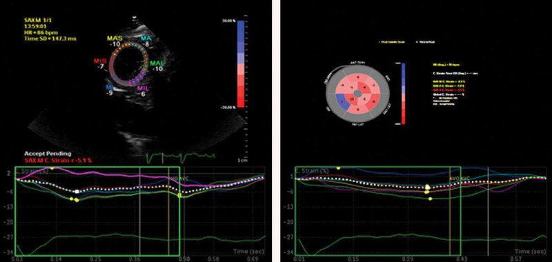 Investigarea pacientului cu cardiomiopatie dilatativă