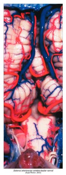 Tratamentul malformaţiilor arteriovenoase intracraniene (1)