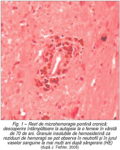 Microhemoragiile cerebrale (2)