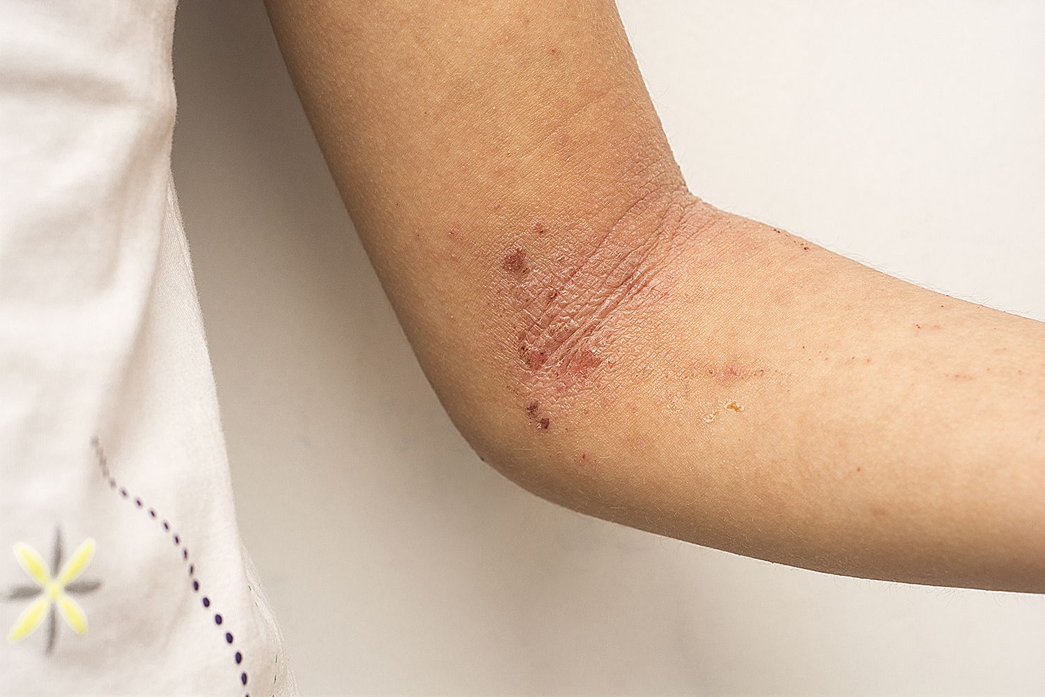 Ajutor în caz de eczemă atopică | Dermatita atopică | oldones.ro