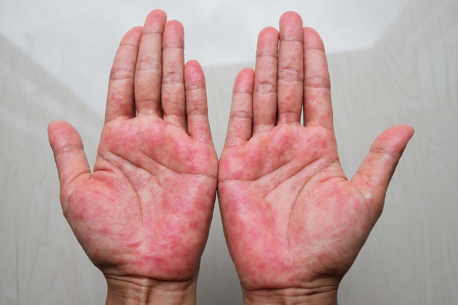Dermatita atopica (eczema) | p5net.ro