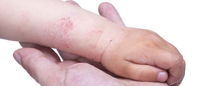 Dr. Diana Plăcintescu: „Un singur episod de eczemă nu pune diagnosticul de dermatită atopică”