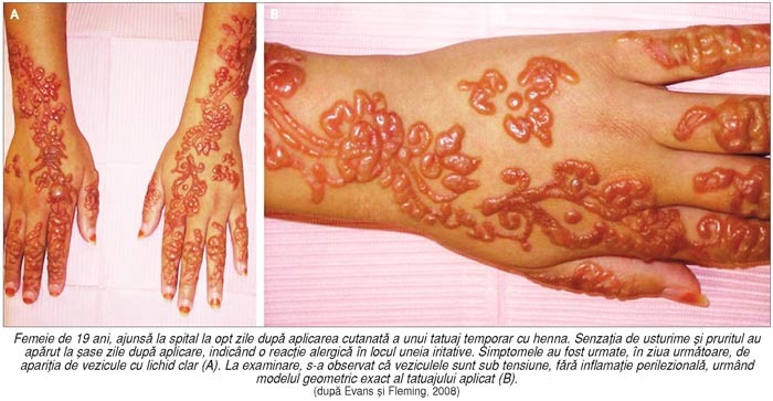 Dermatita de contact la henna