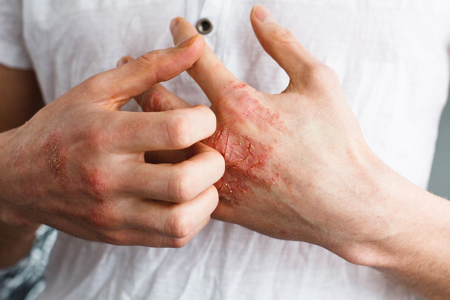 Dermatita atopică, dincolo de bariera cutanată