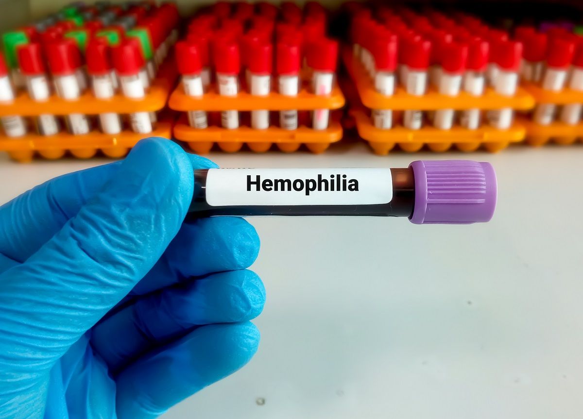 Hemofilia dobândită. Impact clinic