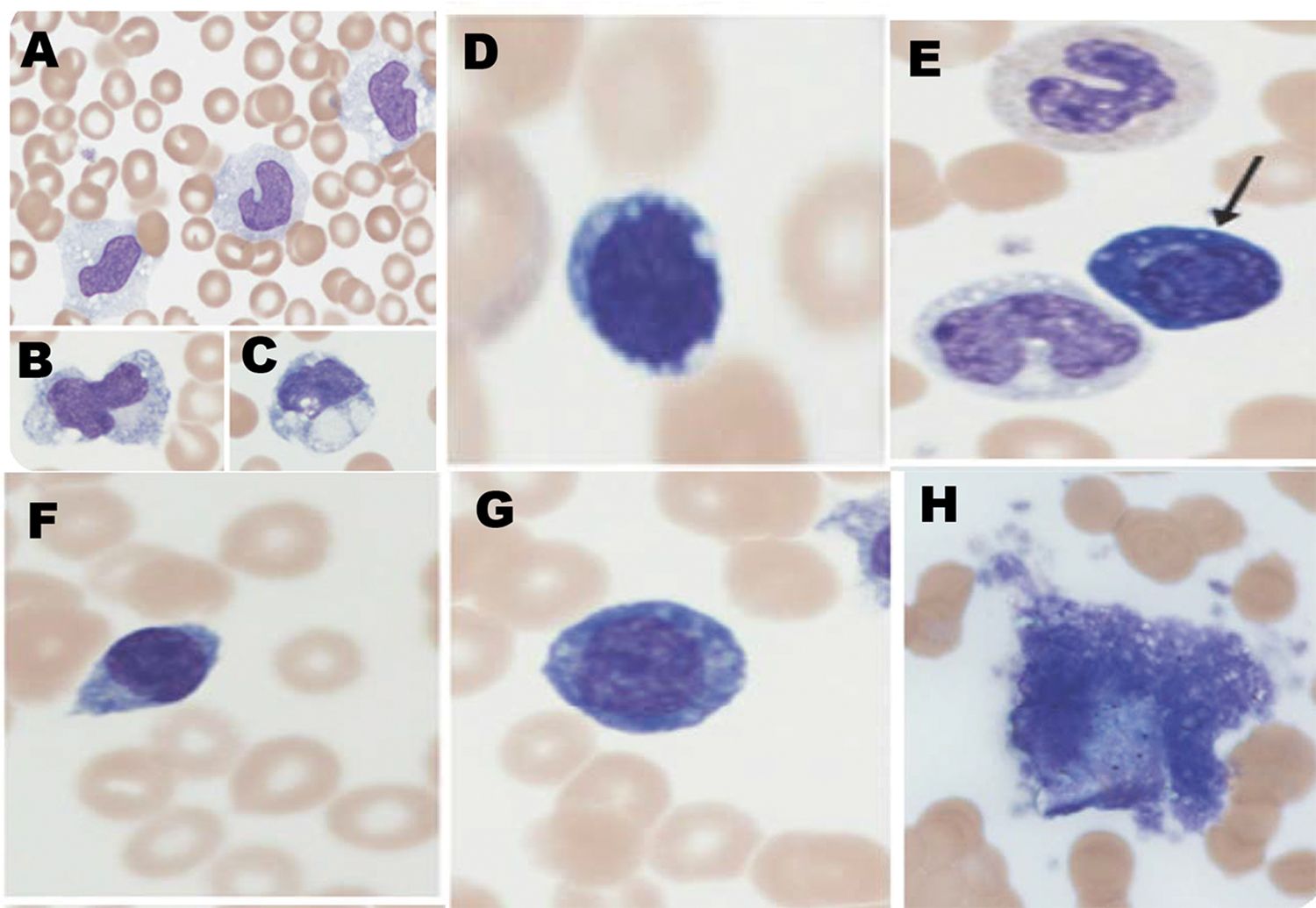 Aspecte hematologice noi în COVID-19